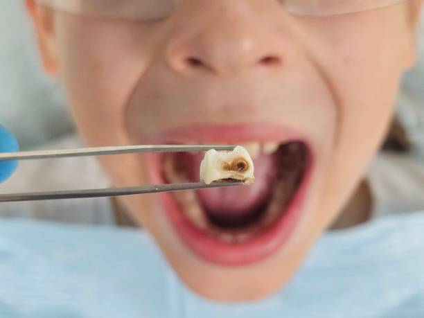 Best Emergency Broken Tooth Repair in Fairview, UT